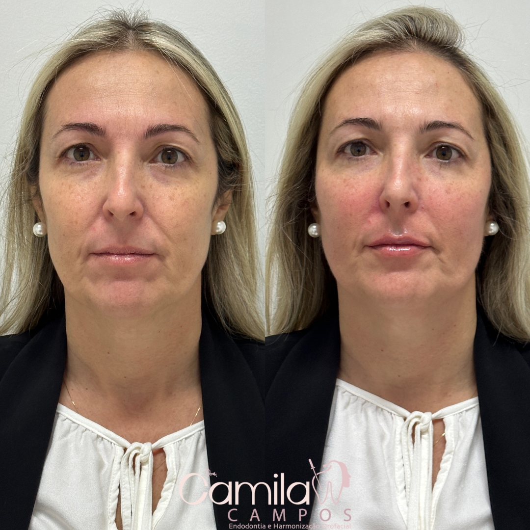 Rejuvenescimento Facial