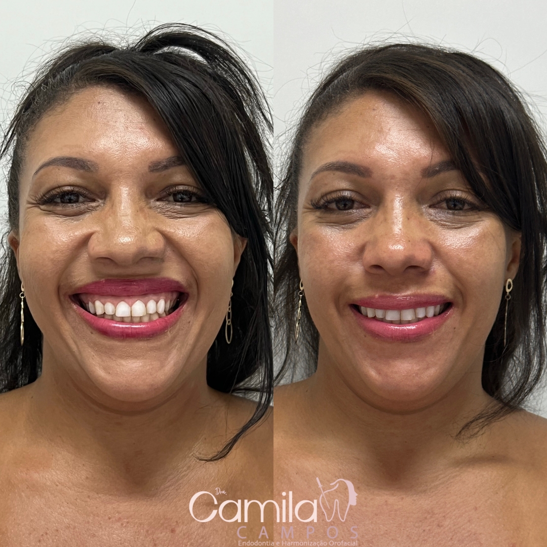 Sorriso Gengival